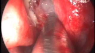 Intact Uncinate FESS