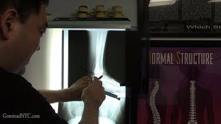 Severe swollen ankle pain - FIXED with Gonstead Chiropractic
