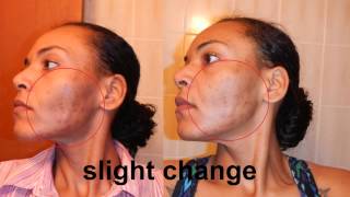 My Bad Acne Scars Honey Skin Care Experiment (Part1) Before and After @catrionaakacat