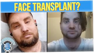 Ex-Soldier Shows Off Remarkable Full-Face Transplant