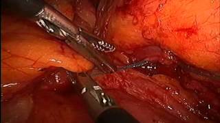 Laparoscopic gasless zero-ischemia partial nephrectomy