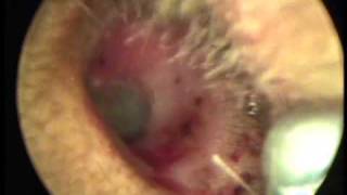Live Cockroach in the Ear - Dr Ahilasamy ENT