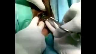 Medical Videos  Remove a Bulb from Vagina