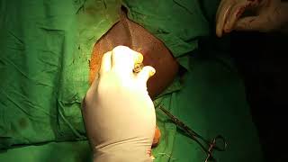 Open haemorrhoidectomy