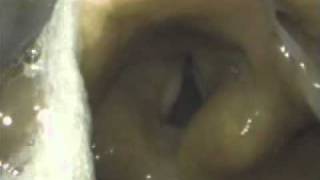 Intubation with video laryngoscopy