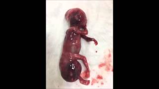 Sacrococcygeal teratoma (SCT) Semih Ozeren Erkan Türköz