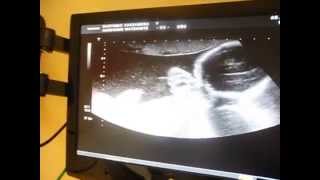Echographie 4 mois et demis de grossesse