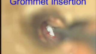 Myringotomy Grommet insertion.