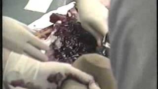 Severe Facial Trauma Shotgun Wound GRAPHIC MEDICAL SCENE