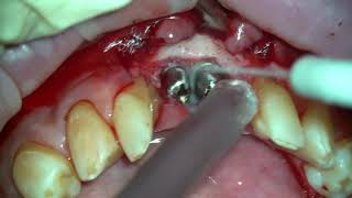 Установка формирователей десны на имплантаты Dentium