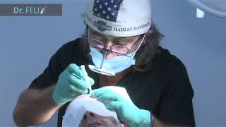 Testimonial Client Dr Felix Hair Implant - Best FUE Hair Transplant Surgery Clinic in Eastern Europe