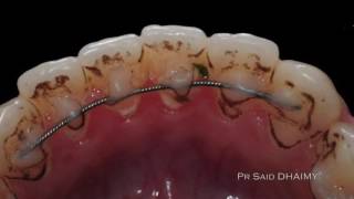 The black stains treatment with the sandman air abrasion system by Pr. Said DHAIMY