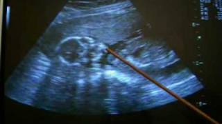 Es NENA!  Antonella con 19 semanas