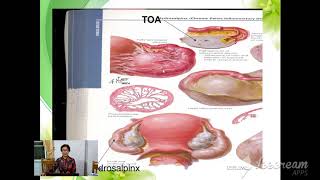 Pelvic Inflamatory Disease