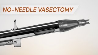 Vasectomy: No Needles, No Scalpels, No Discomfort