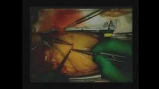 Surgery - Coronary Artery Bypass Graft