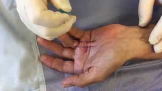 Dupuytren's contracture new treatment, minimally invasive needle cordotomy