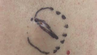 Dr. Pimple Popper Performs A Cyst Excision
