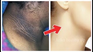অবাক কান্ড!! ঘাড়ের কালো দাগ আর নেই - How To Get Rid of Dark Neck In 7 Minutes - Koko Healthy Tip