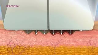 Fractora - фракционный лифтинг