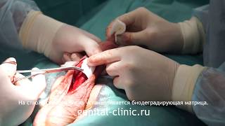 Операция по увеличению члена - утолщение