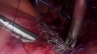 Tratament prolaps genital  (promontofixatie laparoscopica)  Dr. Mitroi Gabriel