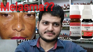 Melasma,Hyperpigmentation,झांँई!Homeopathic medicine for melasma?explain!