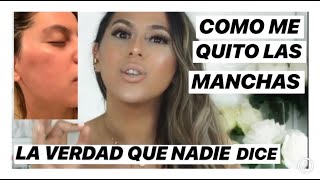 COMO QUITAR LAS MANCHAS DE LA CARA/MELASMA/ EL PAÑO/ LINREVE / HYPERPIGMENTATION/ JACKIE HERNANDEZ