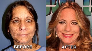 Check out Woman’s New Look after Tumor Removal Procedures