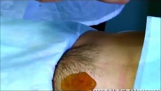 Депиляция фитосмолой. Бикини дизайн. Шугаринг