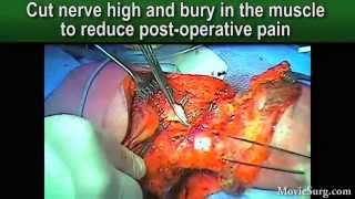 MovieSurg - Above knee amputation