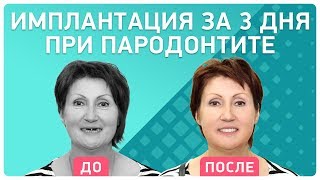 Как восстановить ВСЕ зубы за 3-4 дня ? об имплантации от реального пациента клиники Smile-at-Once