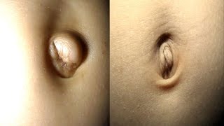 How to heal naval outies naturally - नौसेना आउटरीज़ कैसे ठीक करें