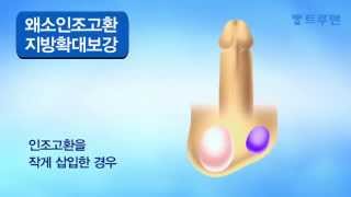 왜소고환 음낭수술 - 트루맨 남성의원