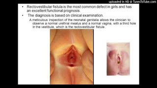 Repair of Rectovestibular Fistula