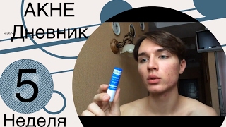 РОАККУТАН моя история 36 день. Обострение