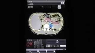 断面図ウォーカー腹部CT