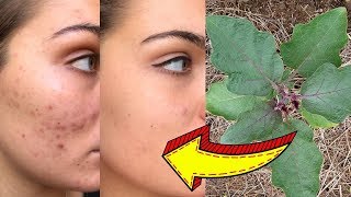 5 REMÉDIOS CASEIROS Para ACABAR Com CRAVOS e ESPINHAS! Como Tirar ESPINHAS?
