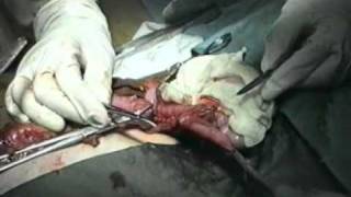 резекция кишечника, анастомоз, стома-Operation on intestines