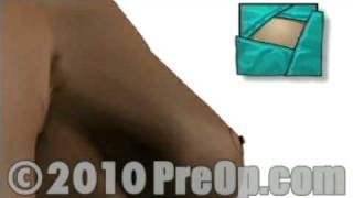 PreOp® Educación del Paciente Seno Biopsia con aguja