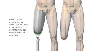 Implant Keep Walking La solution pour  l´amputé transfémoral