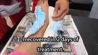 Sprain treatment 2nd day (13 year old girl)