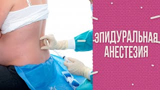 Эпидуральная анестезия