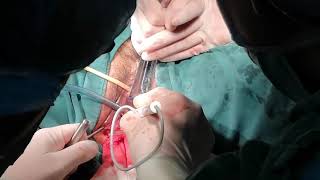Vaginal myomectomy for non-prolapsed uterus