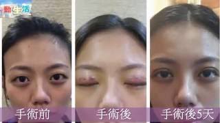 動生活-Skin Medical Centre雙眼皮吊線手術整個過程現場實錄(附字幕)
