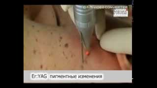 Лазерное удаление пигментации в Пятигорске.