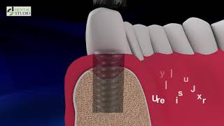 Набор для удаления имплантов Dental Studio Implant Remover Kit