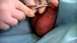 no scalpel vasektomie