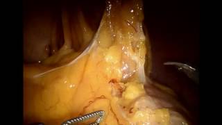 Роботическая Бильрот 1 дистальная резекция желудка. Robotic Billroth 1 subtotal gastrectomy.