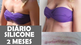 Diário de Um Silicone: 2 meses - Cicatriz - Sutiã - Inchaço